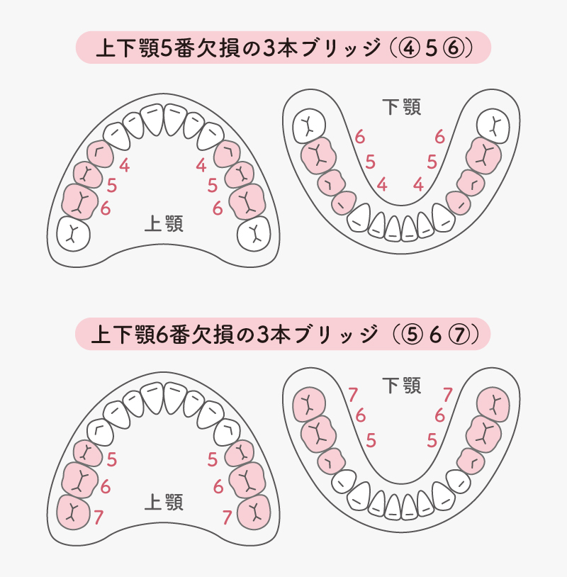 SHIN-BOWの適用範囲